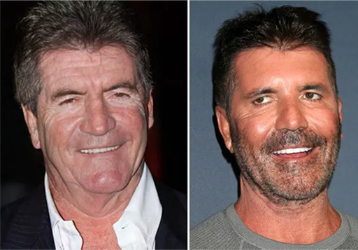 Simon Cowell Before After_
